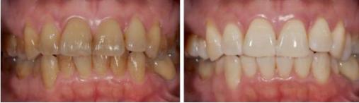 四环素牙为何会在我国盛行,四环素服用多久出现四环素牙