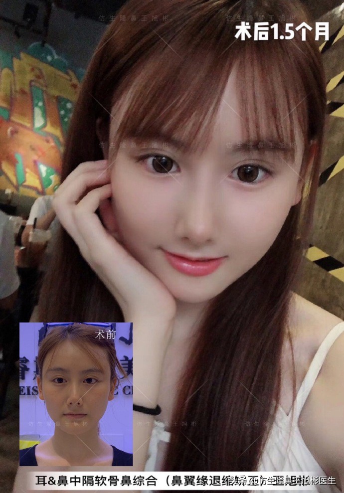 王旭彬:朝天鼻、露鼻孔,模特菲菲短鼻矫正手术后1.5个月