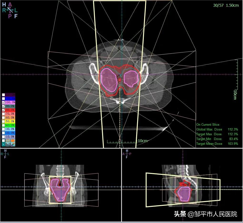 放疗三个疗程35次,三院放疗科
