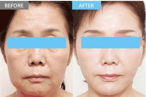 玻尿酸打完变美,把全脸的玻尿酸溶了