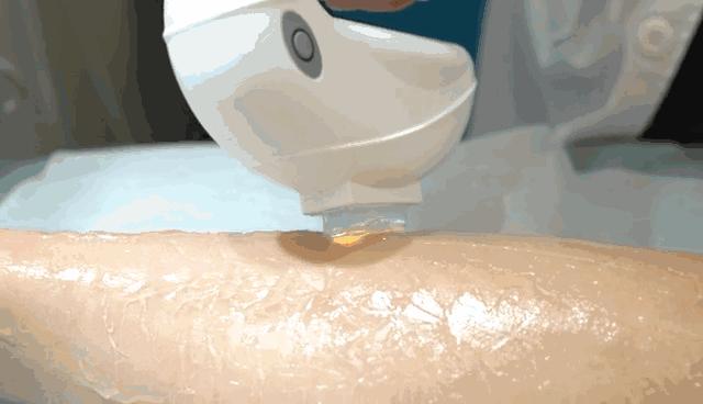 冰点脱毛仪哪个牌子脱毛效果最好,360脱毛和冰点脱毛有什么区别