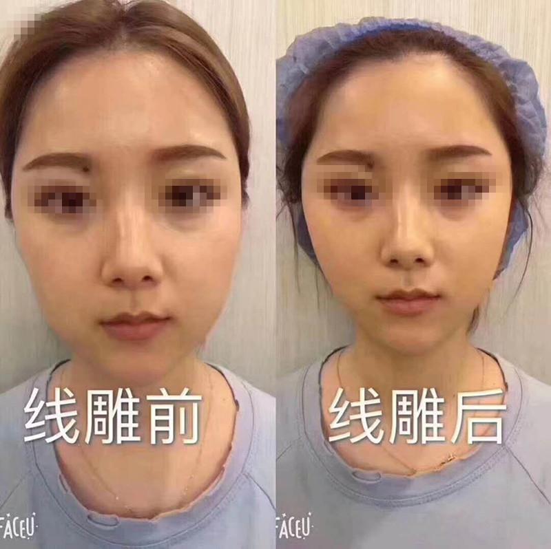 无针逆龄线雕全脸抗衰,抗衰线雕怎么做