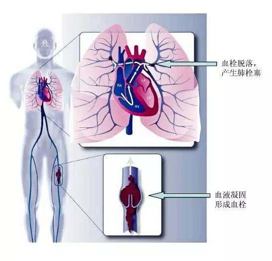 下肢静脉血栓要命吗,下肢静脉血栓能用热水泡脚吗