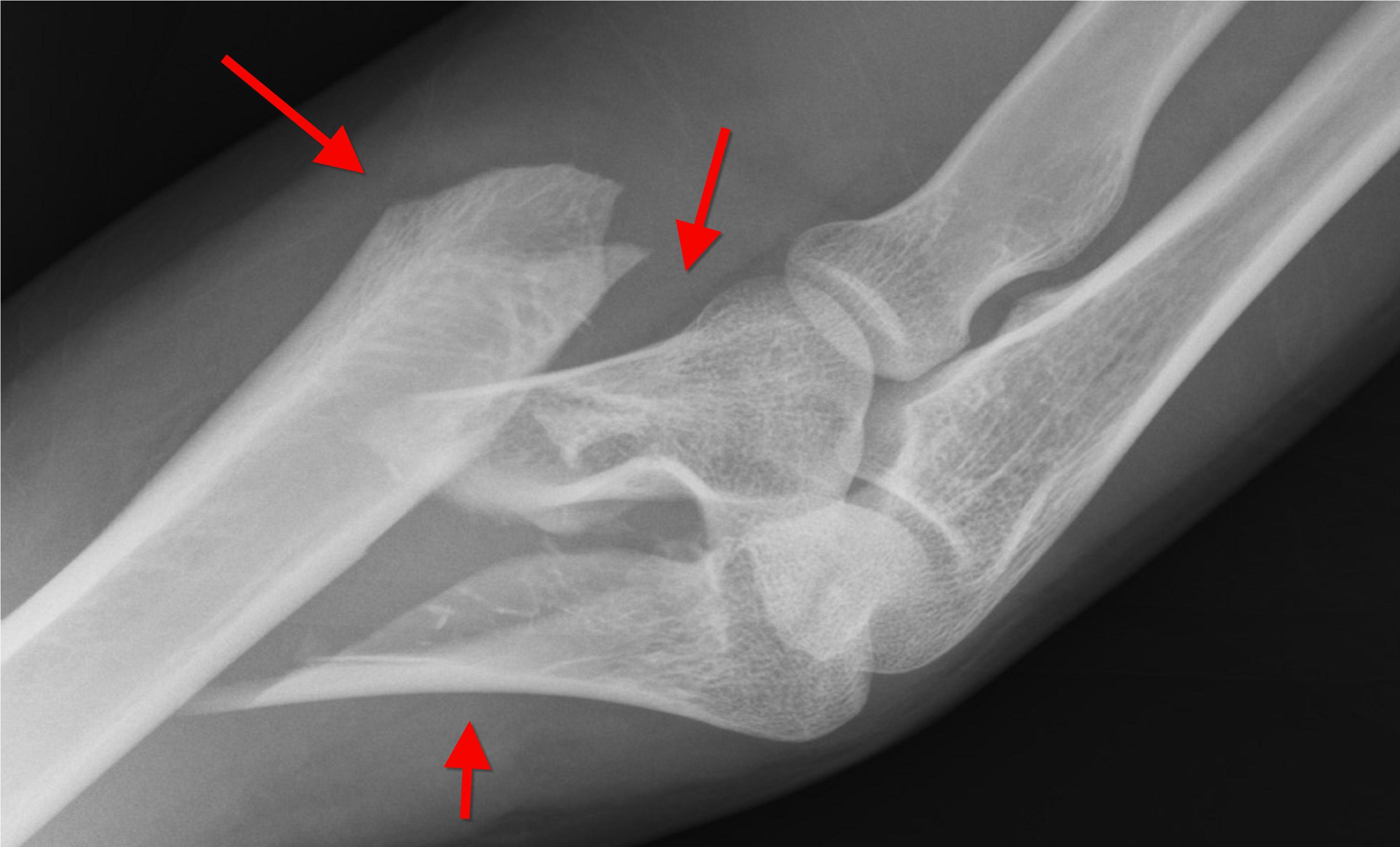 你知道伤筋动骨一百天,但不知道骨折要这样护理,恢复得又快又好