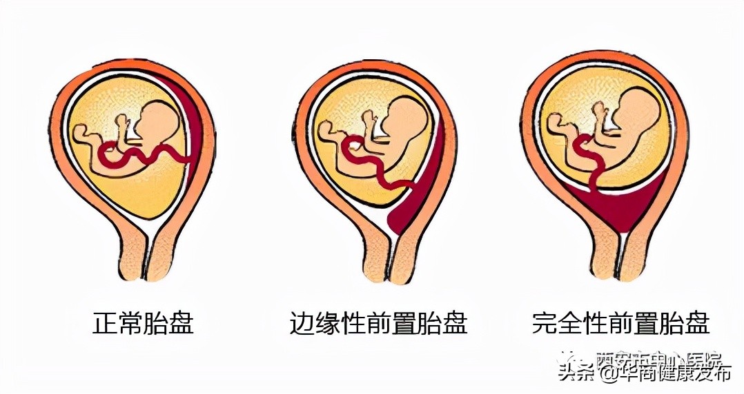 为什么容易发生前置胎盘,前置胎盘到底可不可怕