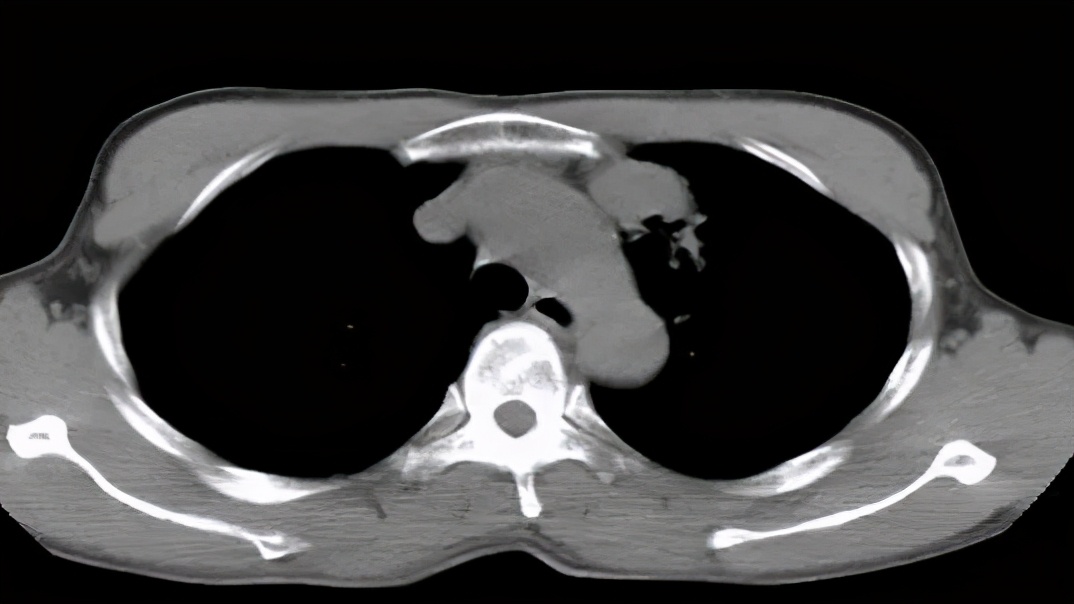 肺结核防控诊疗方案,成功治疗肺结核病的关键