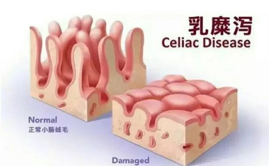 菌群问题,过敏与肠道菌群失调有关吗
