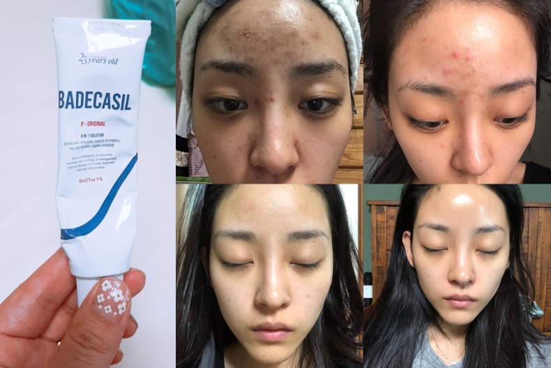 真的很可以买！韩妞最爱用「去疤乳膏TOP3」讨厌的痘印全都掰