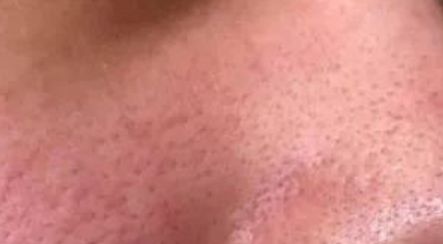 拯救毛孔粗大测评,毛孔粗大拯救全过程