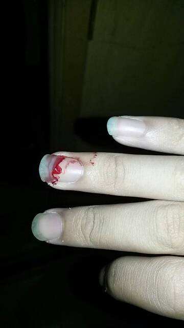 指甲盖被劈了咋办,指甲盖长劈了一半