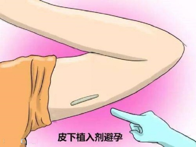 哪种方式避孕好伤害小,哪种避孕方式对女性伤害小