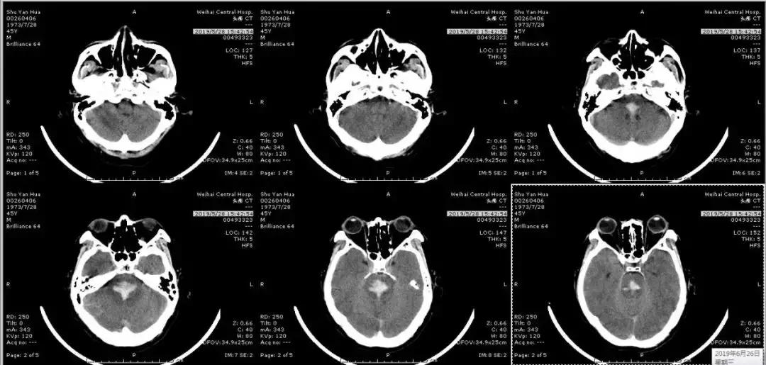 脑干出血五毫升还有救吗,脑干出血5ml危险期