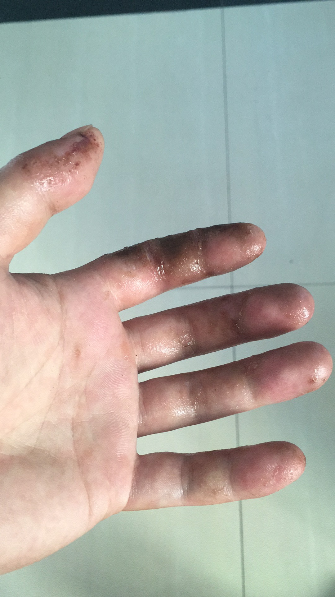 望大V能够分享一下|真实经历分享#钓鱼人#职业病之香虎手治疗方案