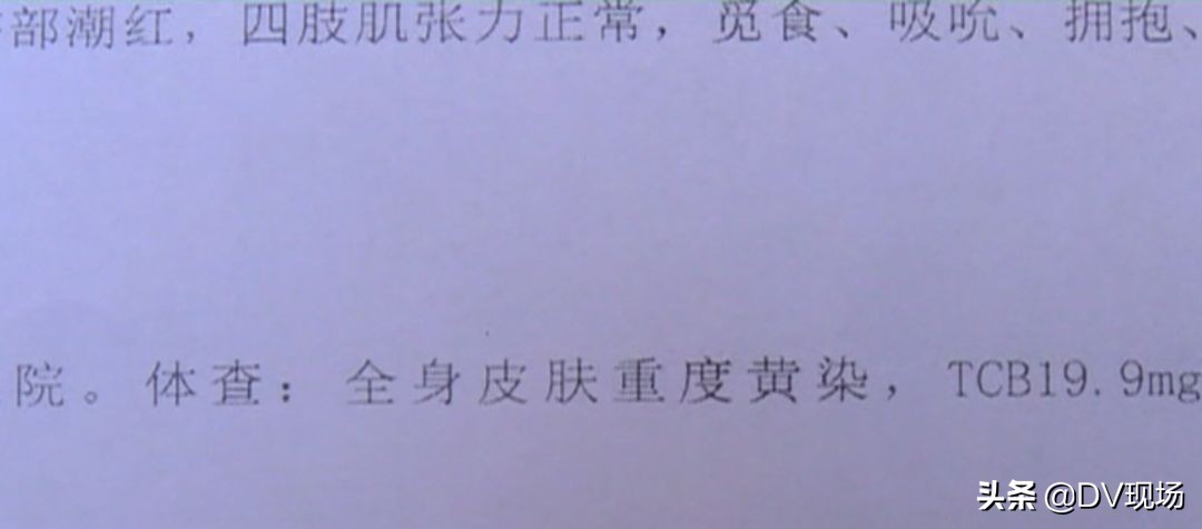 刚满月小孩得黄疸死了,出生6天住院治疗黄疸