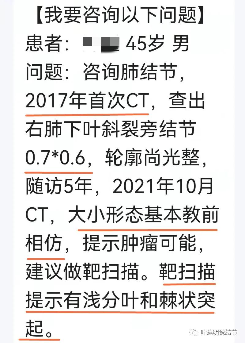 问诊分析：存在了4年的实性结节会不会是肺癌？