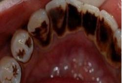 牙结石要怎么处理,自己在家处理牙结石