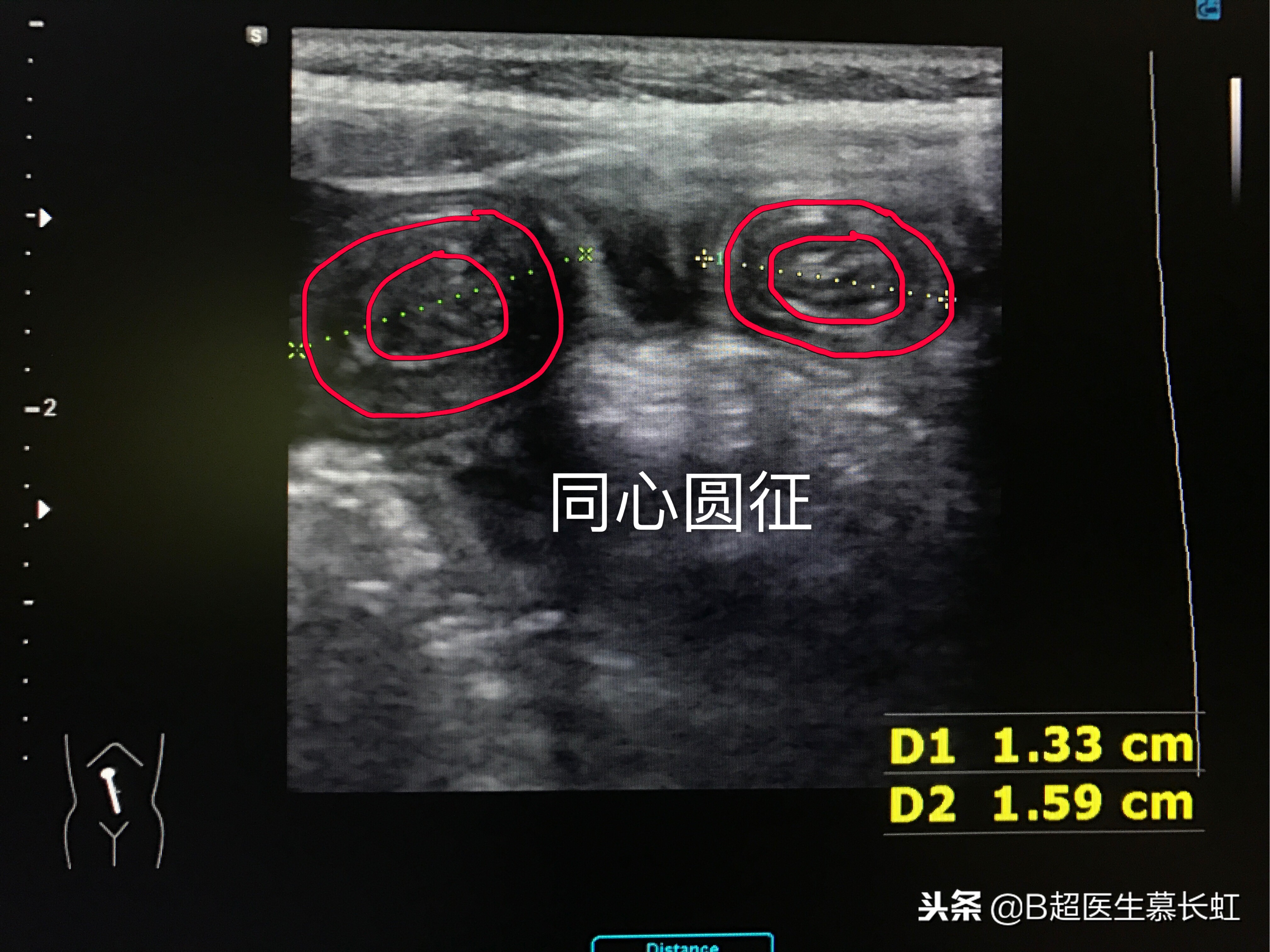 儿童肚子疼呕吐拉血怎么回事,2岁宝宝说肚子痛肠套叠
