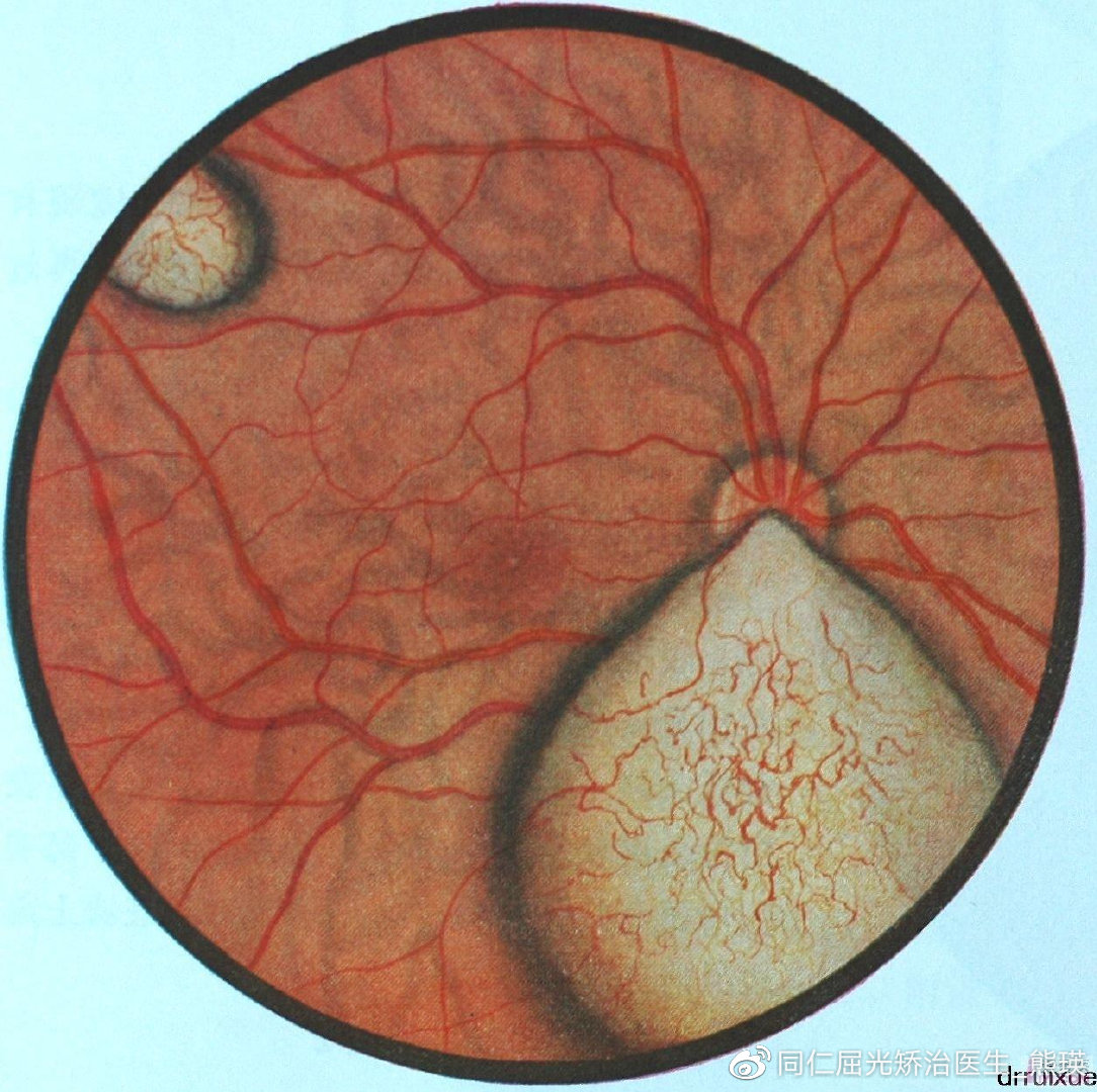 眼科护理手册最新版,眼底病科普手册