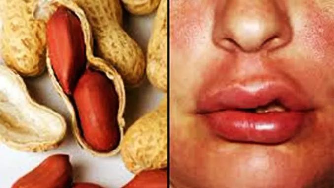 什么样的花生能引起过敏,花生过敏怎么急救