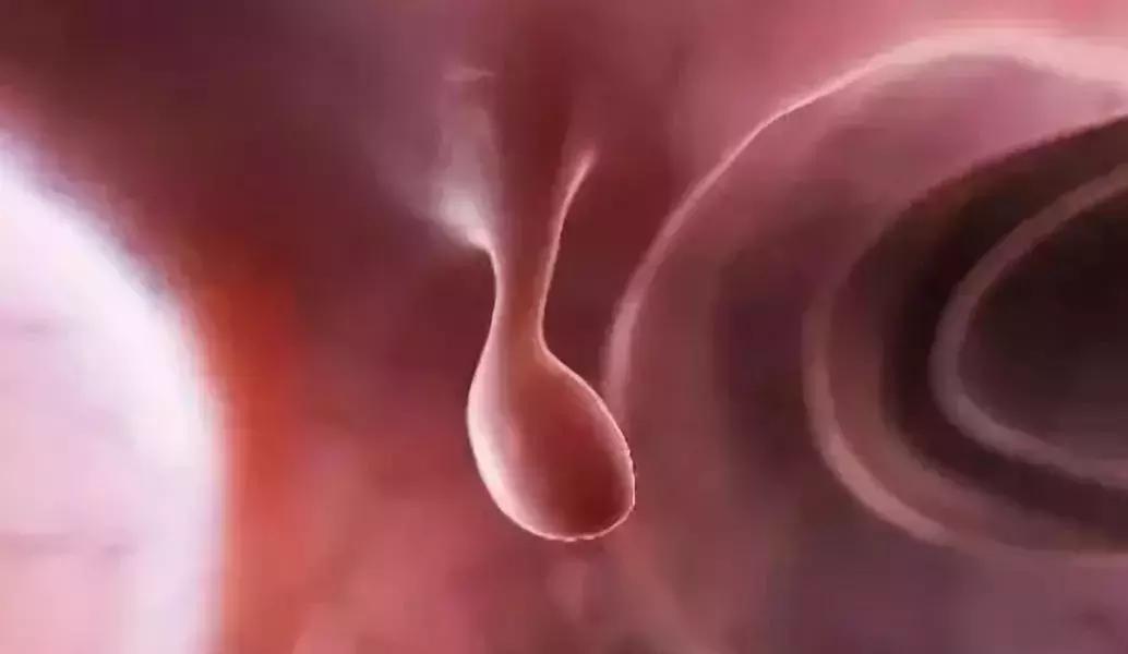 艾灸治息肉的最佳方法,息肉最怕的克星艾灸