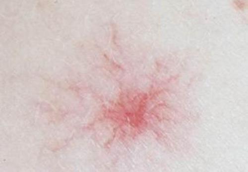 怀孕后发现胸口有一颗蜘蛛痣,孕妇怀孕皮肤有胎记