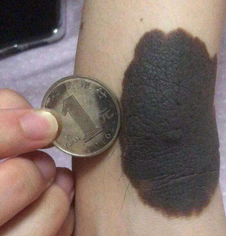 哪些黑痣容易恶变?需要切除吗?