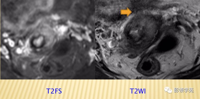 宫颈癌mri诊断,宫颈癌的mr扫描技术