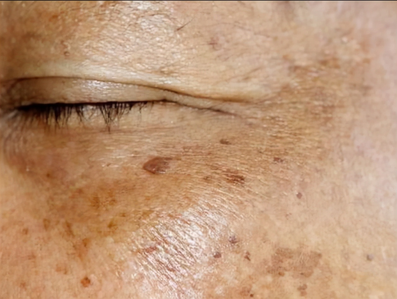 老年斑一刮就干净,年轻人起了老年斑是什么原因