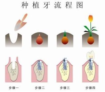 老人戴假牙有哪些注意事项,老人的活动假牙能咀嚼吗