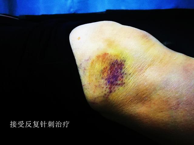 面对多种治疗半月板损伤的办法，我们应该做加法还是做减法？