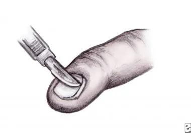 解决甲沟炎比较好的方法,甲沟炎很严重怎么修