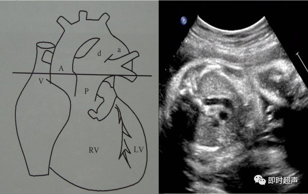 胎儿心脏三种血管关系模式图,25周的胎儿心脏弓切面多少正常