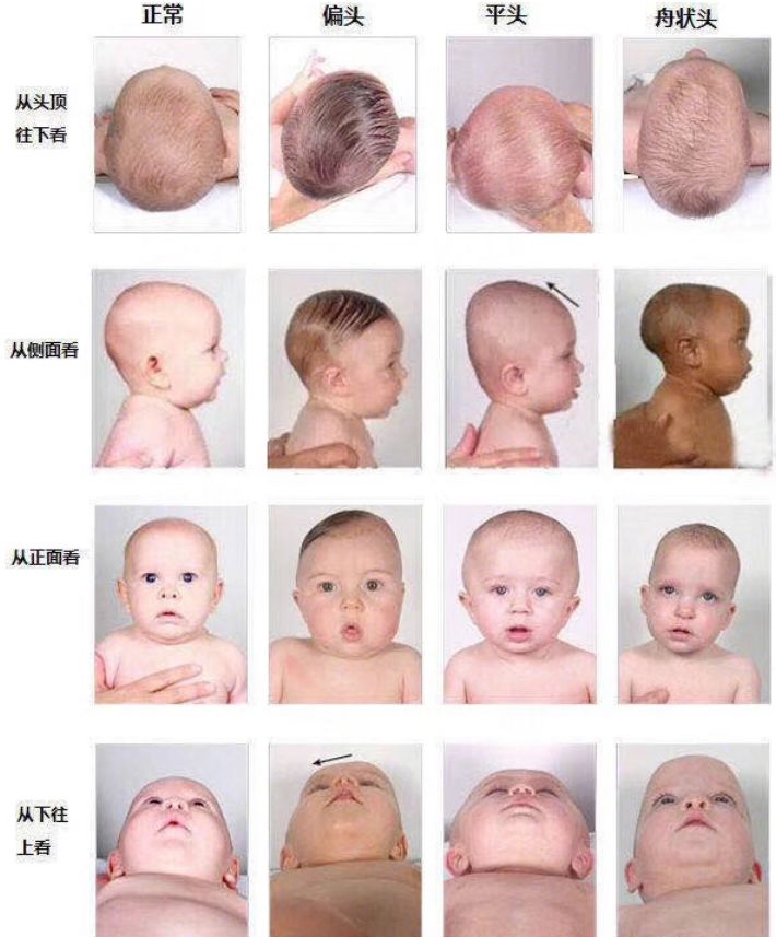 颅顶高扁头怎么睡成圆头,如何拯救高颅顶大扁头