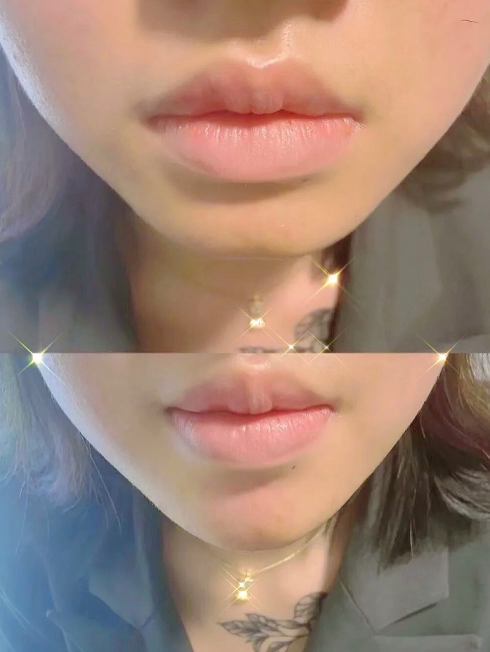 假体垫下巴歪了怎么办,做假体垫下巴后麻是什么原因