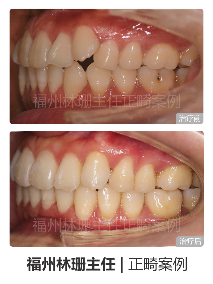 福州晋安哪里矫正牙齿,福州牙齿畸形龅牙矫正