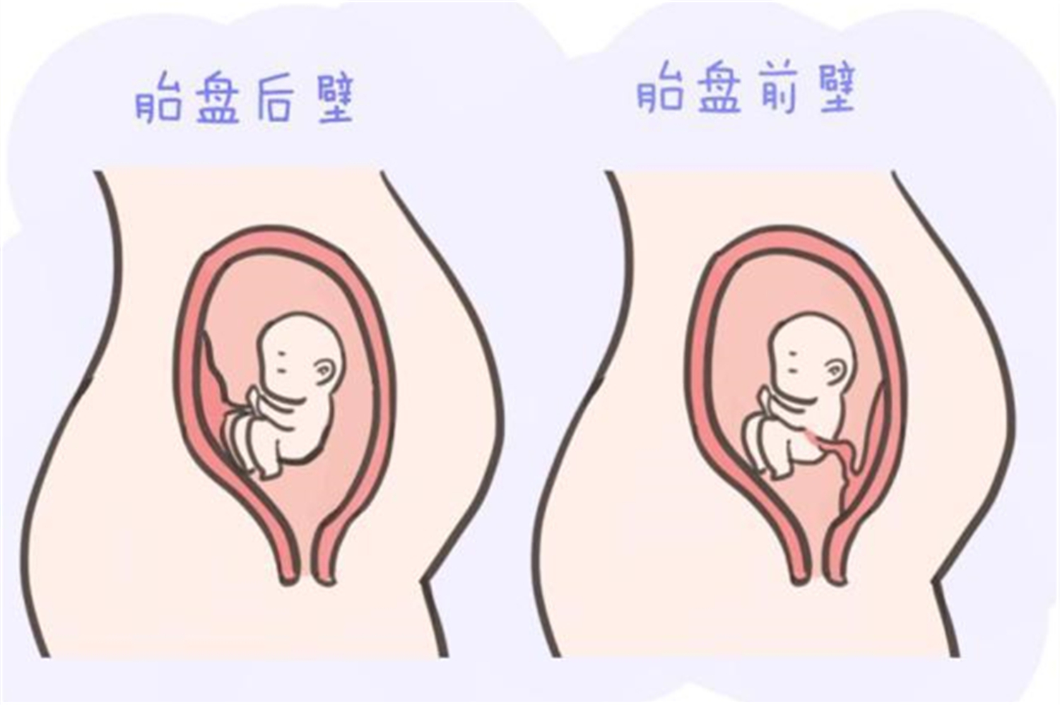 胎盘前壁和后壁的区别是什么呢,胎盘前壁与后壁有什么要注意的
