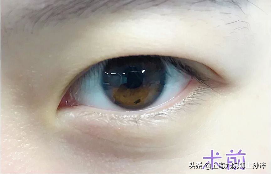 上海九院孙沣博士眼角修复,上海九院美容科孙沣