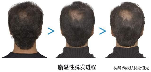 脱发无法治疗后的日常护理,脱发无法挽救