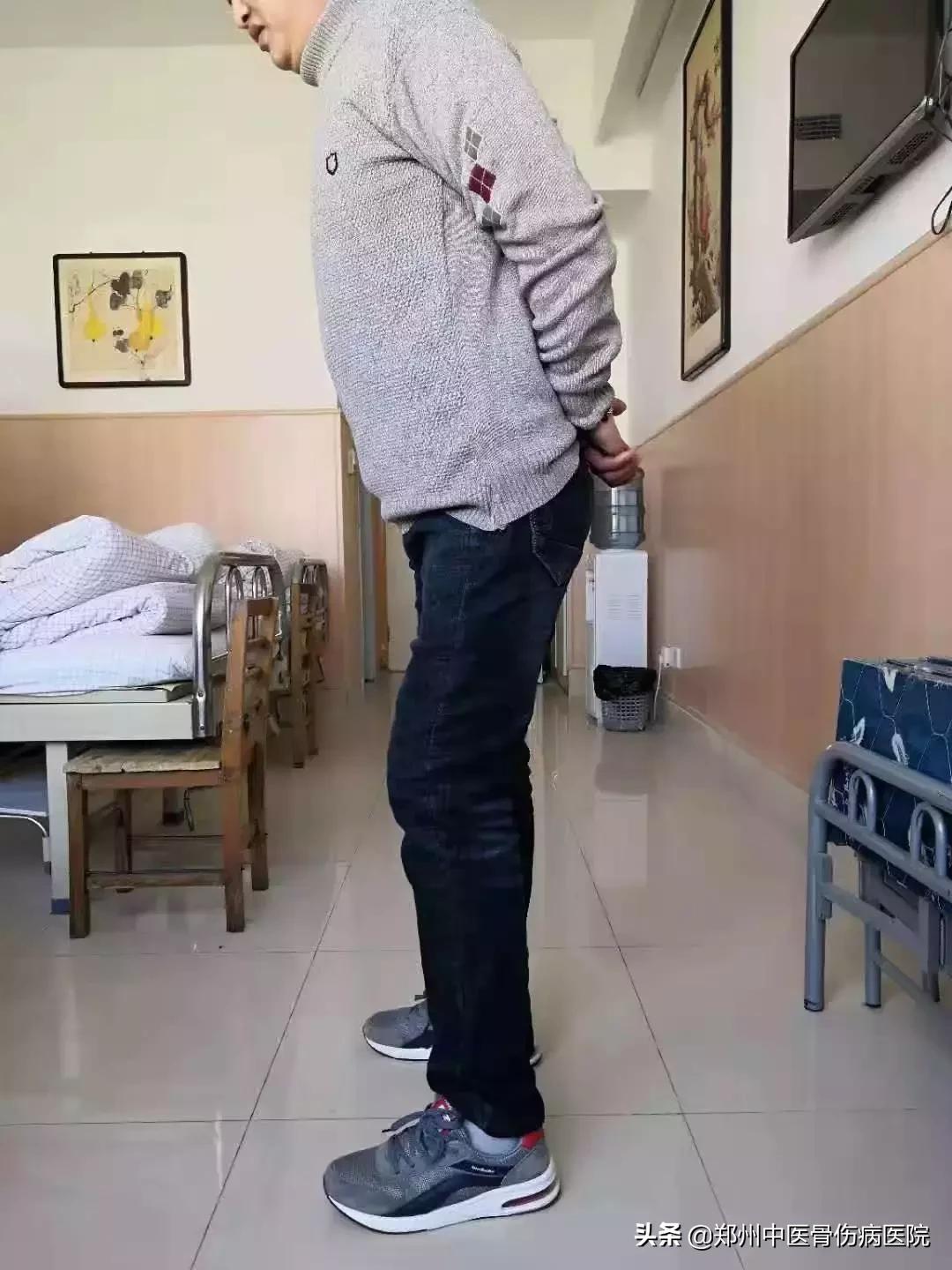 长短腿步态和跳跃性步态,大腿往内旋转纠正步态