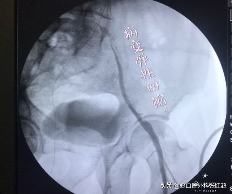 外周血管外科治疗范围,外周血管介入治疗疗程