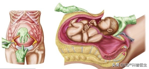顺产10个侧切九个撕裂,十个顺产九个疼是真的吗
