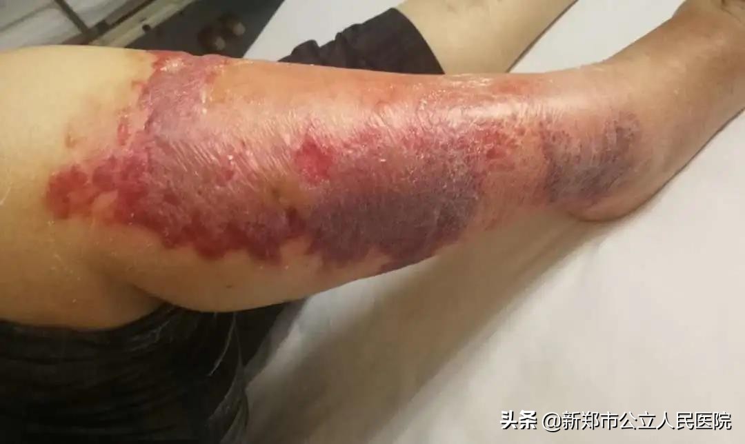 小腿又红又肿又痛还烫,小腿又红又肿