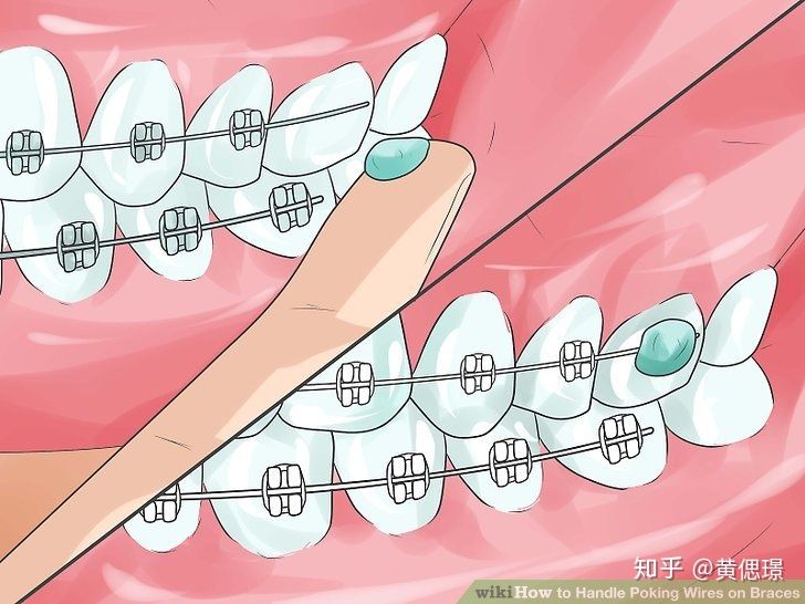 2021年春节期间牙套er应急自救指南