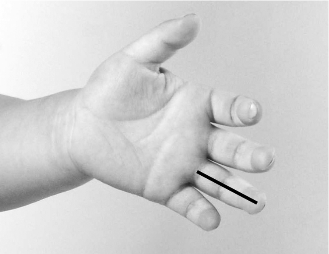 儿童感冒反复发烧怎么降烧,小孩反复发烧物理降温的正确方法