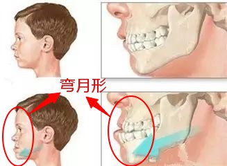 防止地包天的最佳方法,乳牙地包天怎么辨认