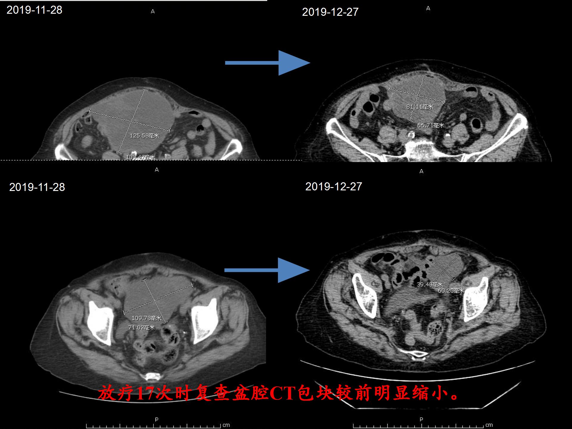 卵巢肿瘤早期化疗会治愈吗,卵巢肿瘤剥离后化疗
