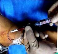 PICC冲封管不到位？来看看问题出在哪里吧