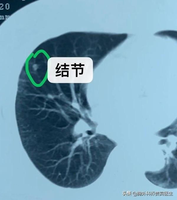 早期肺癌首选的治疗方法是,肺癌早期alk突变要吃靶向药吗