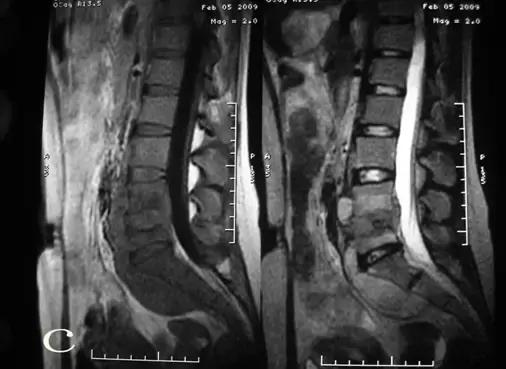 腰椎结核吃什么药疗效快,腰椎结核简短介绍