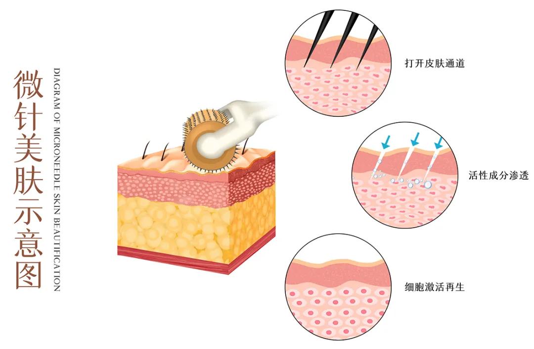 先破后立原理的美容仪有哪些,微针一般治疗以后多久恢复